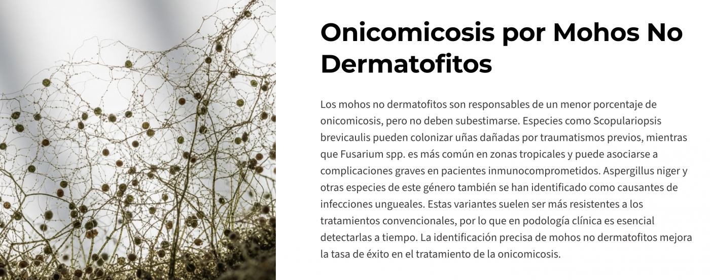 Onicomicosis